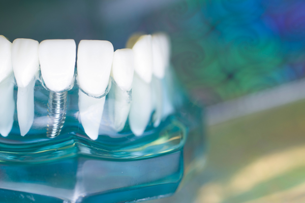 Myths About Dental Implants
